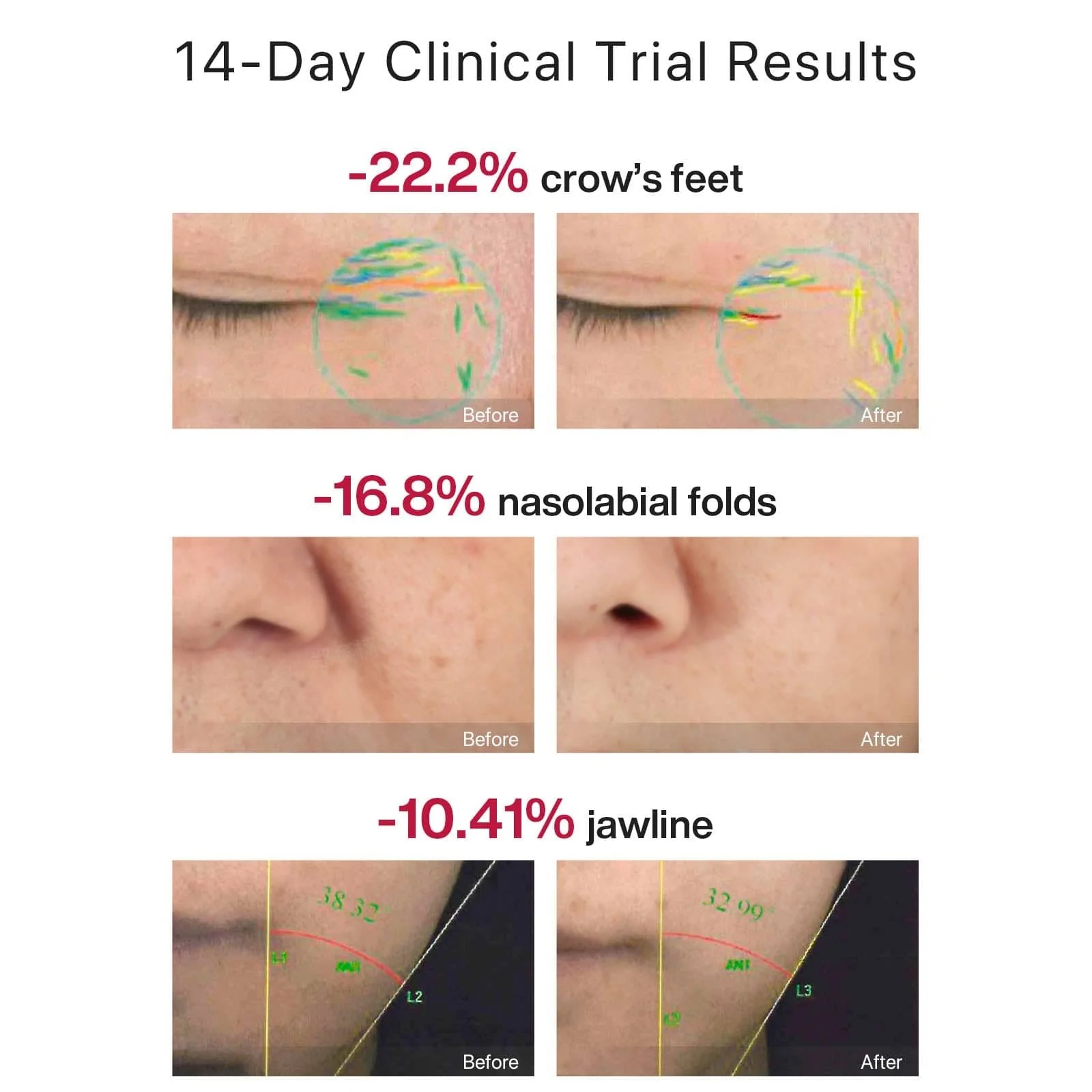 *LIMITED PINK* AMIRO R1 PRO Facial RF Skin Tightening Device "Chinese Version"