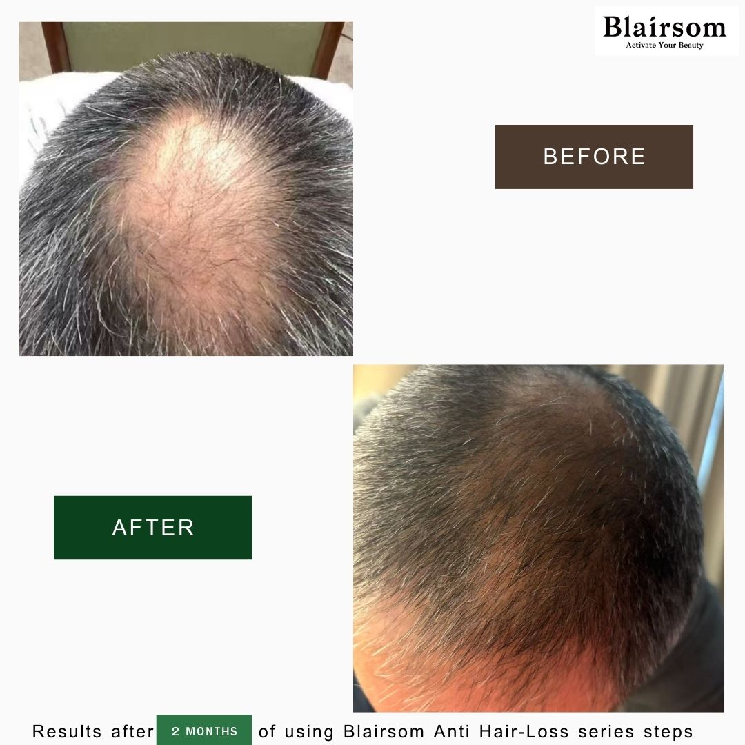 Blairsom Anti-Hair Loss Shampoo 300ml