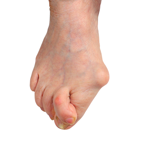 Bunions: Causes and Treatment-HAPPY WALKER