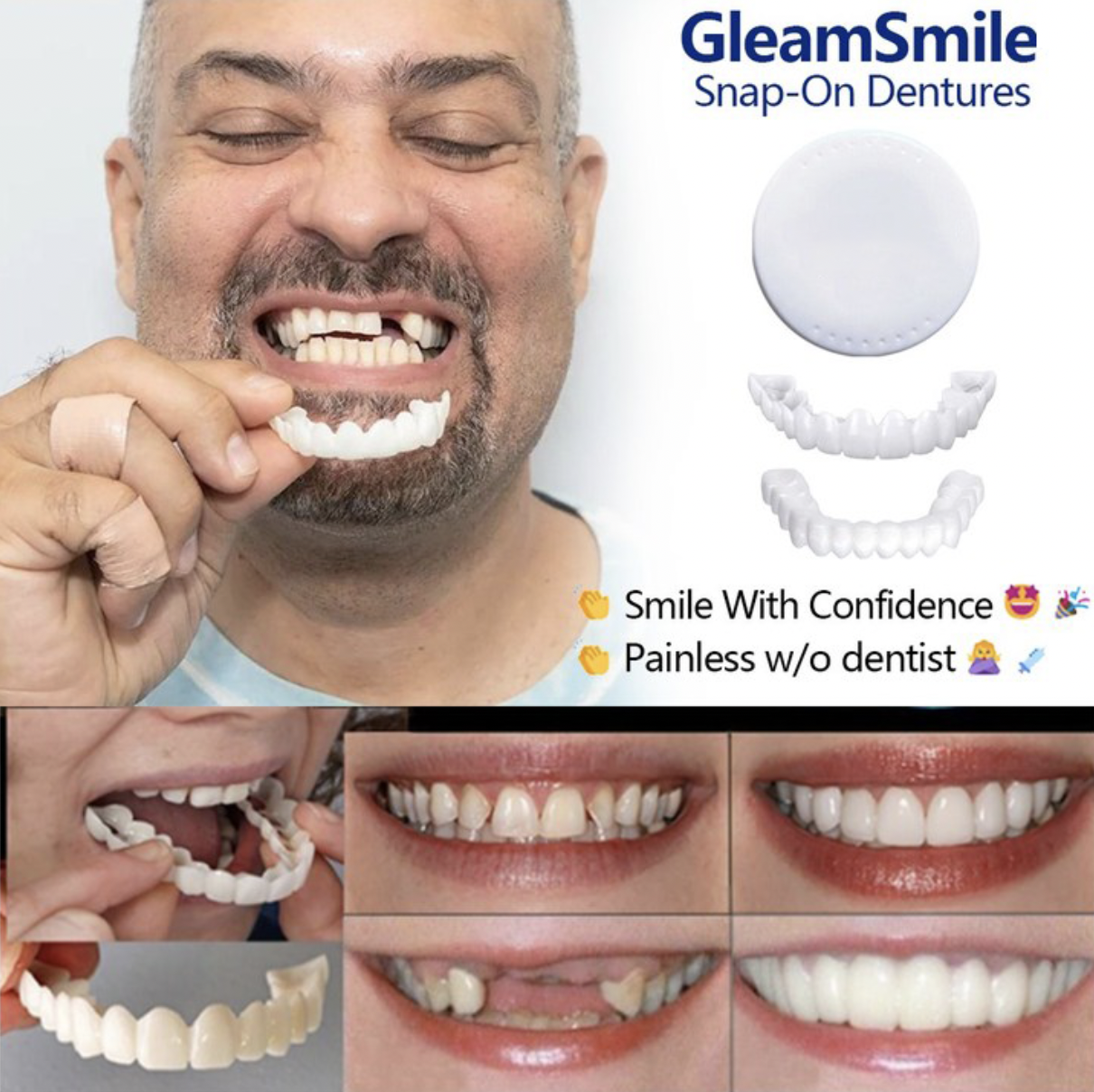 Adjustable SnapOn Dentures