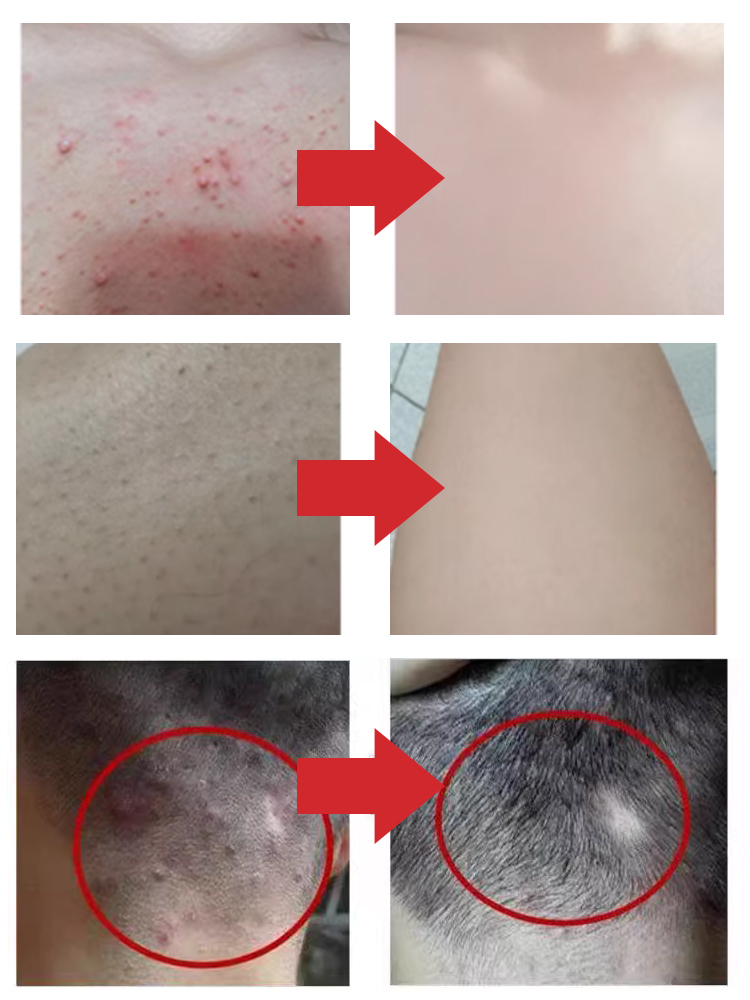 【高效解決背癢頭癢小疙瘩】硫磺除