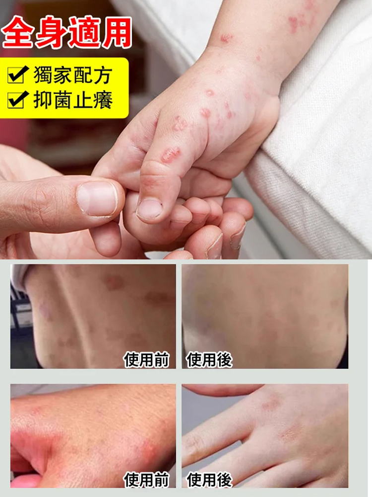 雙黃止癢噴劑