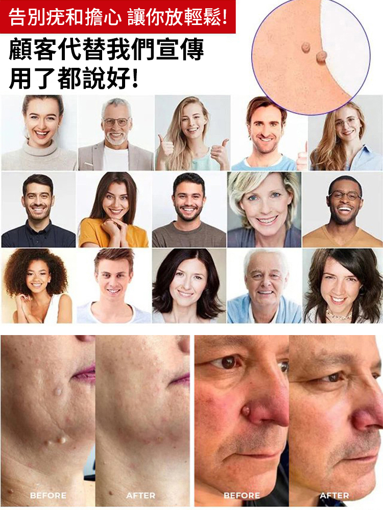 克疣膏抑菌乳膏