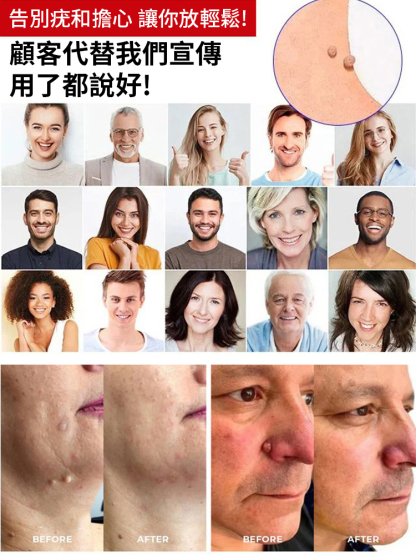 克疣膏抑菌乳膏