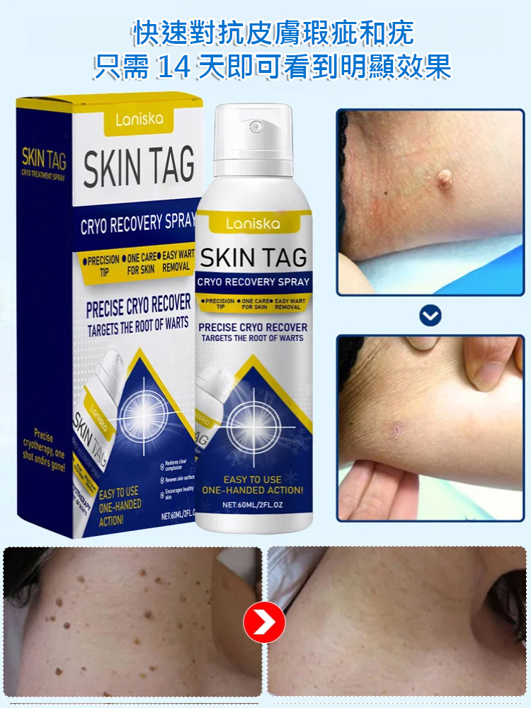 疣點外用護理噴霧