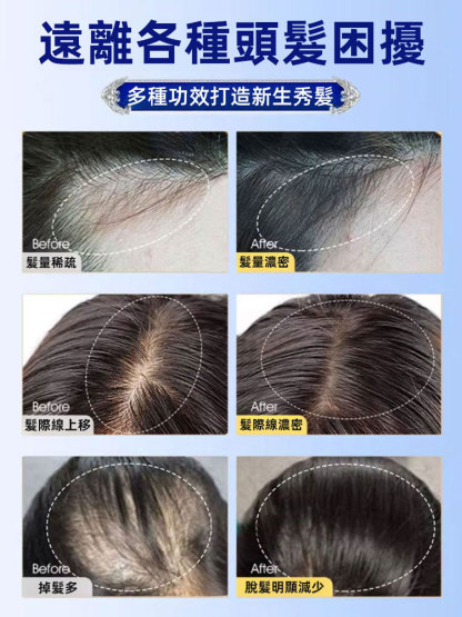 植萃毛炎寧毛囊噴霧