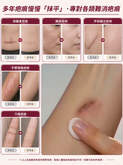 【藏域高原修復秘方】藏牛脂草本疤痕膏