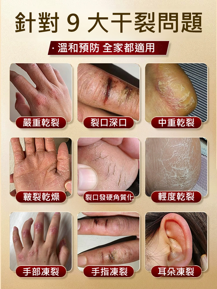 手足皸裂育