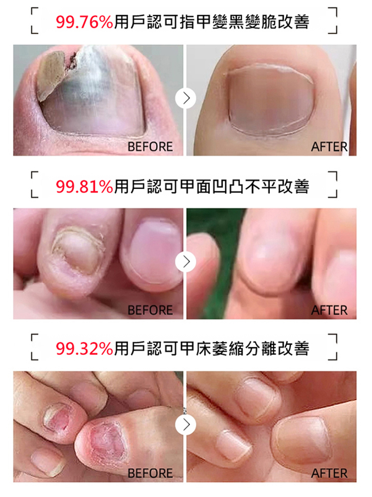 【3天去灰甲】甲康靈