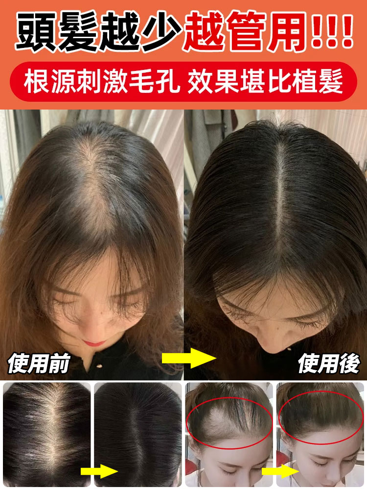 植萃毛炎寧毛囊噴霧