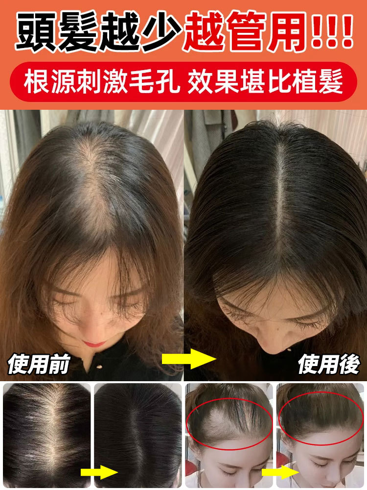 植萃毛炎寧毛囊噴霧