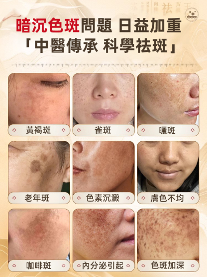 【斑點一抹消】美白祛斑霜