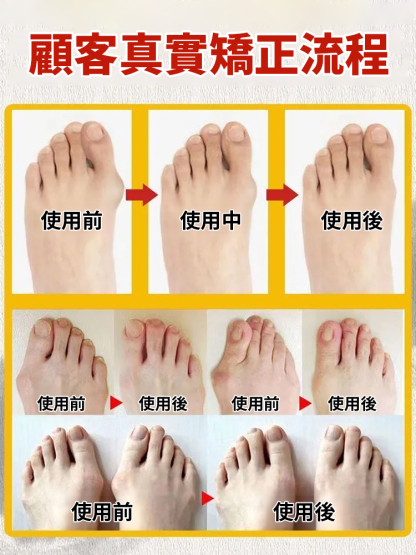 大拇指外翻專用膏