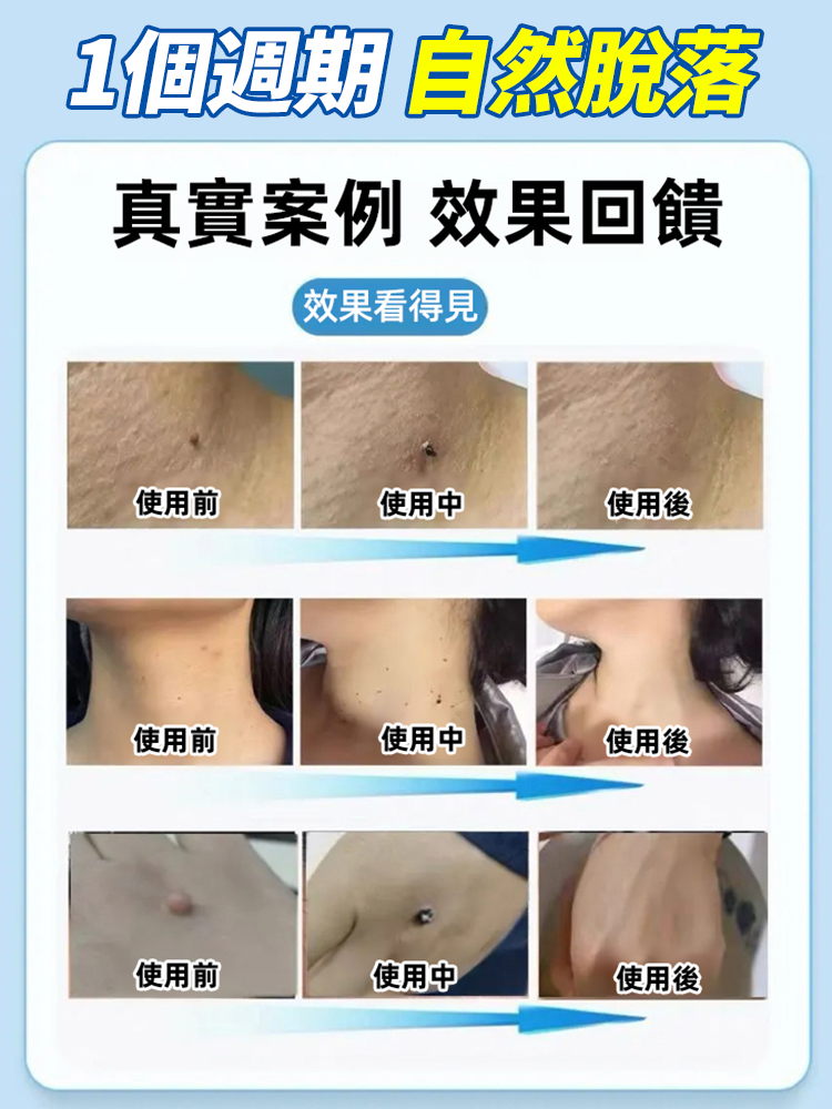 祛疣護理乳膏