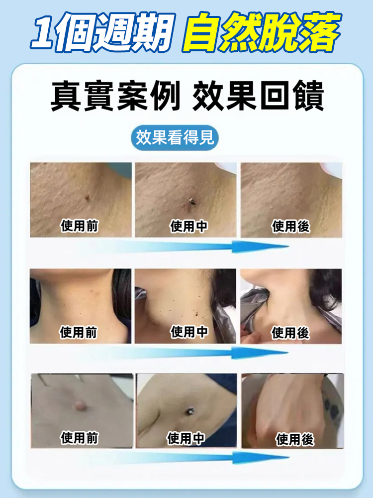 祛疣護理乳膏