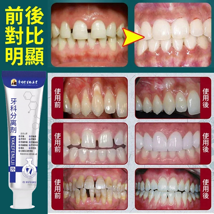 【牙科專供】牙齒分離劑牙膏
