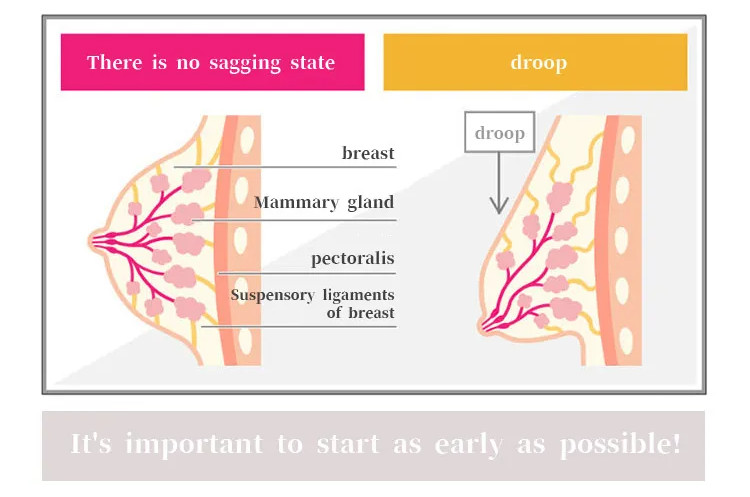 VEIMIA Breast sagging vs no sagging diagram