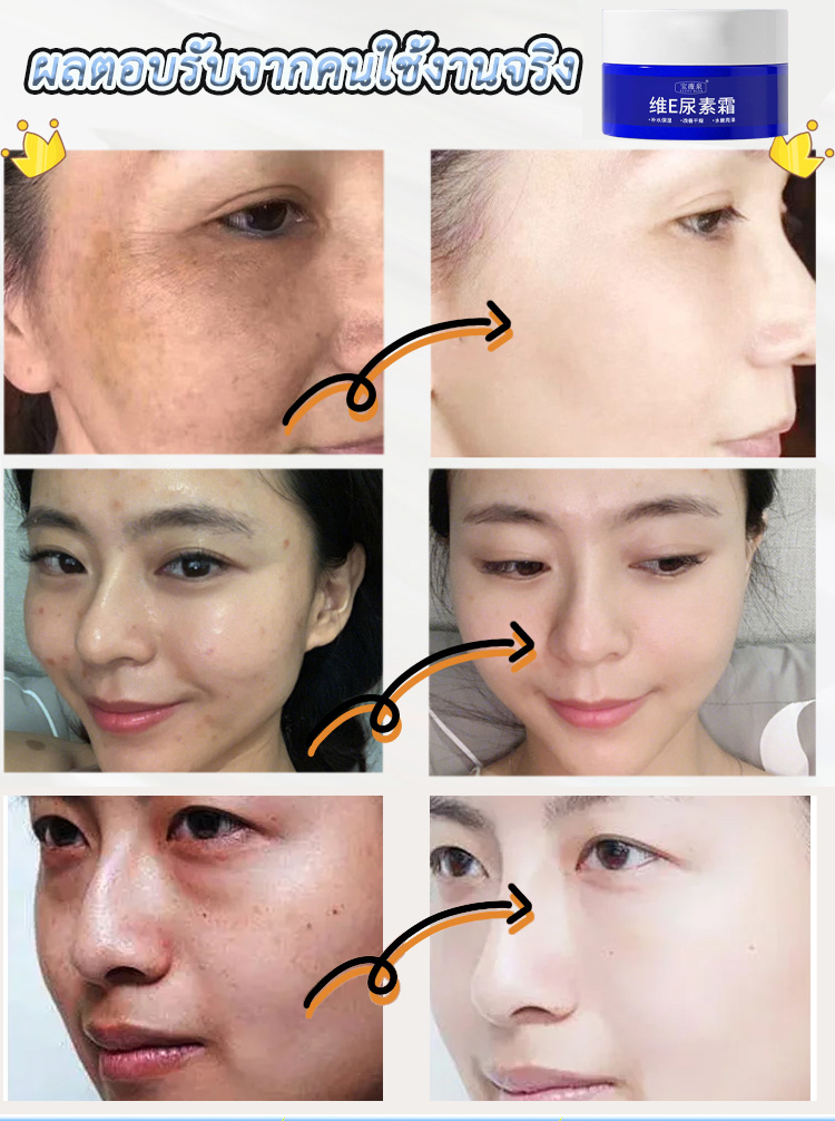 【ทาปุ๊บลดจุดด่างดำ】ครีมยูเรียลดจุดด่างดำ