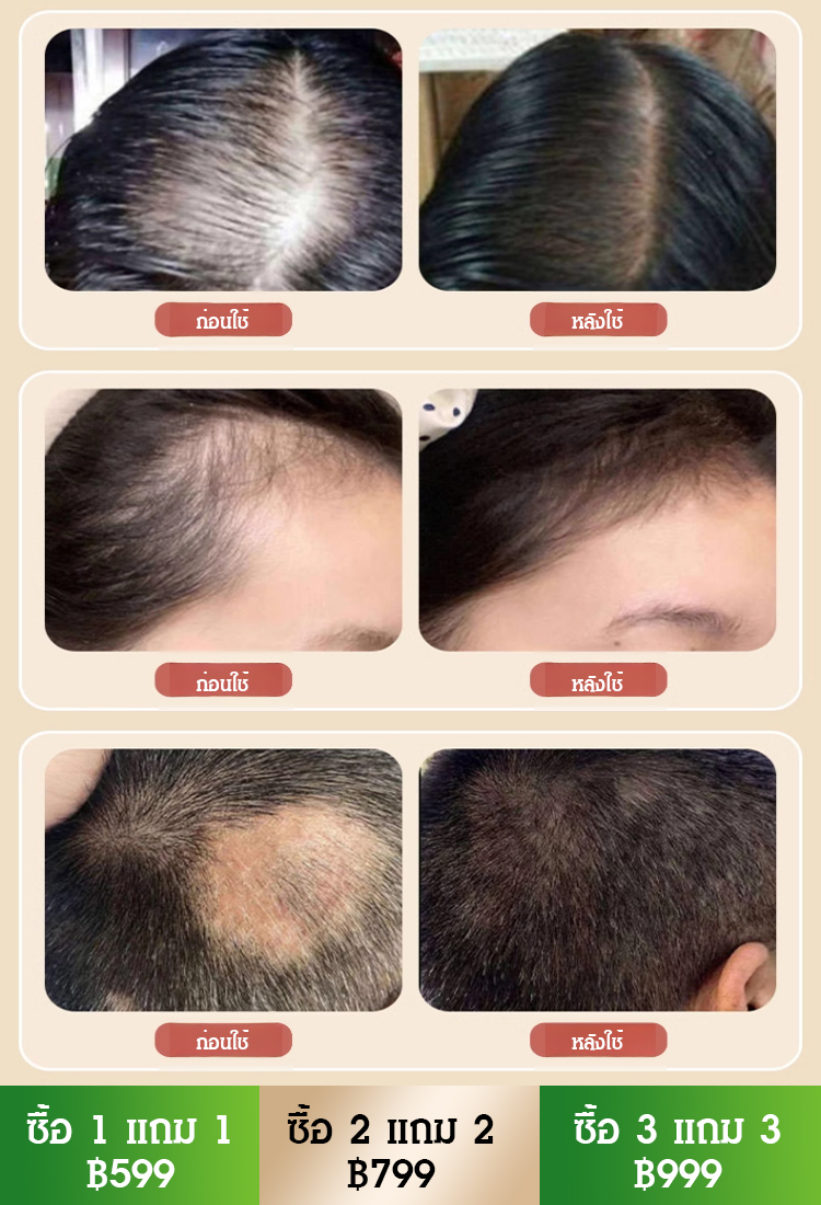 【สูตรปลูกผมสมุนไพรแบบโบราณร้อยปี】 เซรั่มพืชปลูกผมป้องกันผมร่วง