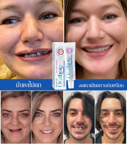 กาวติดฟันปลอมเกรดอาหารสร้างรูปด้วยความร้อน