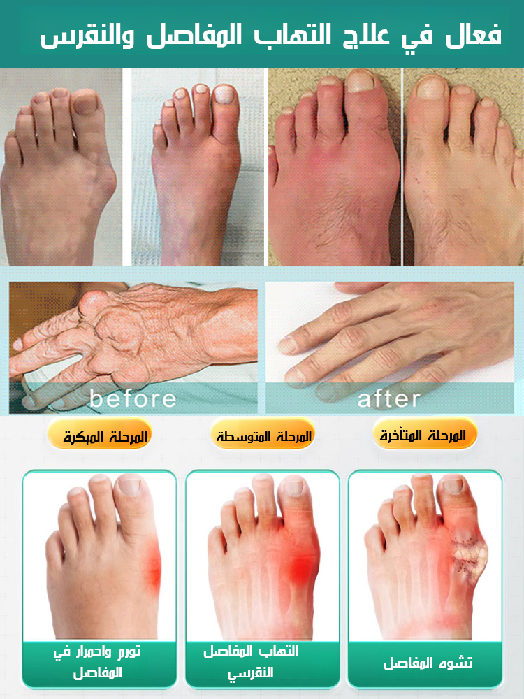 بخاخ رغوي للعناية بالمفاصل