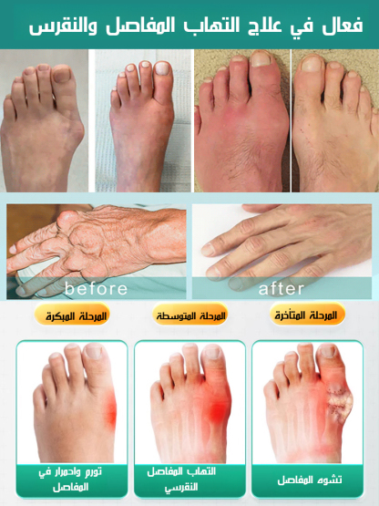 بخاخ رغوي للعناية بالمفاصل