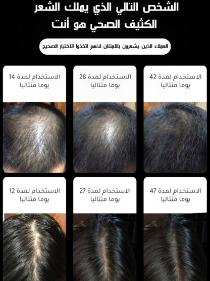 زيت عطري من  مستخلصات إكليل  الجبل لتعزيز نمو الشعر