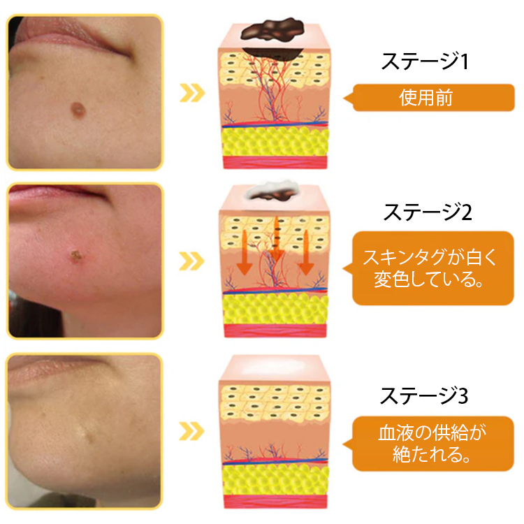 蜂毒成分配合イボ取りスプレー
