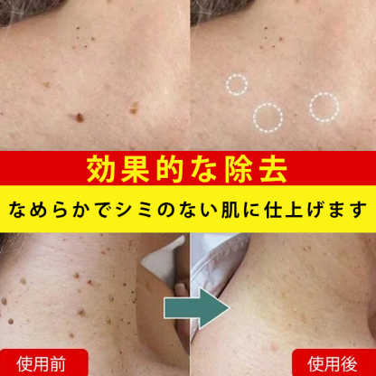 蜂毒成分配合イボ取りスプレー