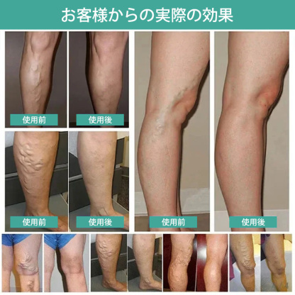 アイスシルク医療用インソール