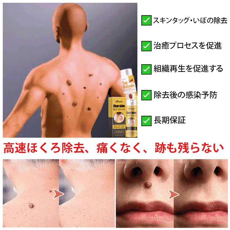 蜂毒成分配合イボ取りスプレー