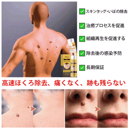 蜂毒成分配合イボ取りスプレー