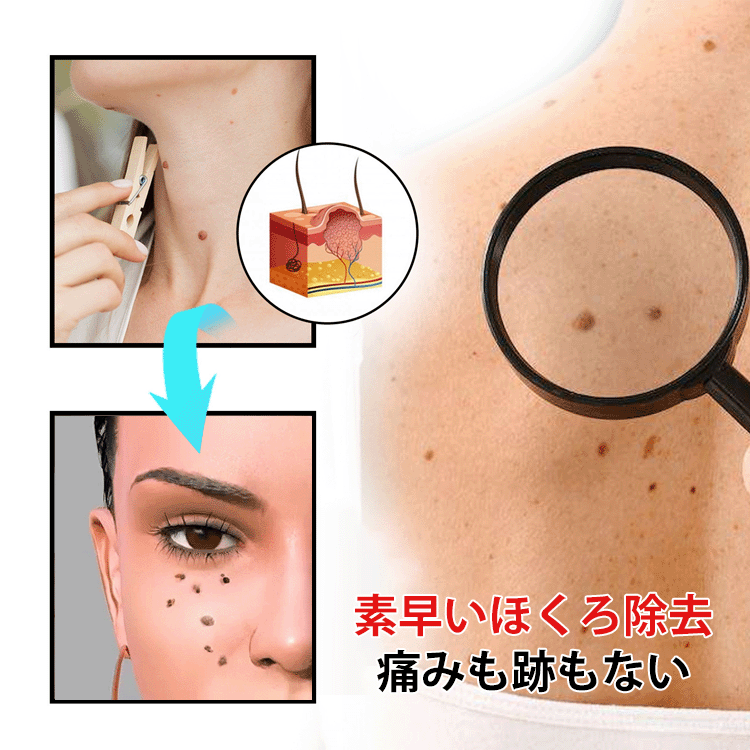 蜂毒成分配合イボ取りスプレー