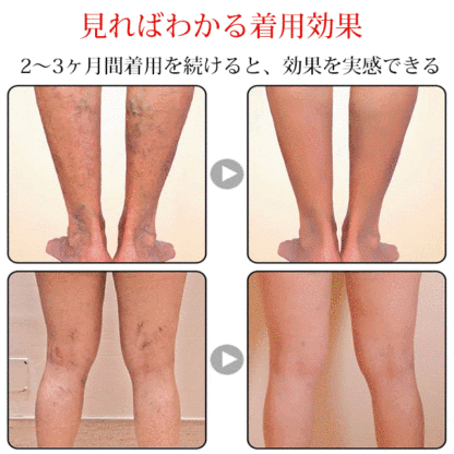 足のむくみ対策ショートストッキング