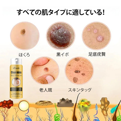 蜂毒成分配合イボ取りスプレー