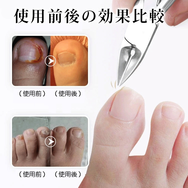 爪白癬専用ニッパー型爪切り