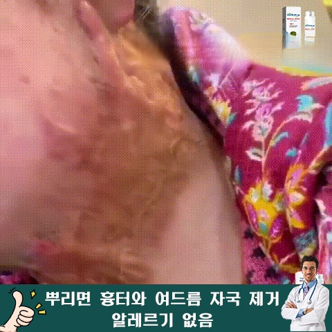 흉터 케어 미스트