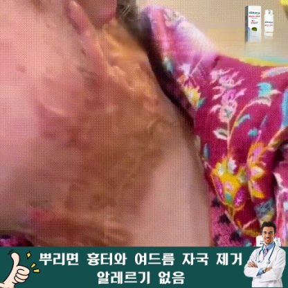 흉터 케어 미스트