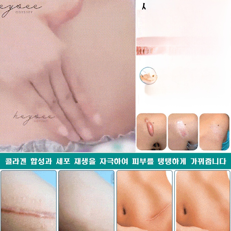 흉터 케어 미스트