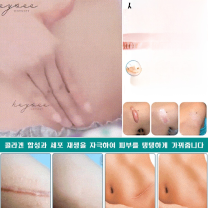 흉터 케어 미스트