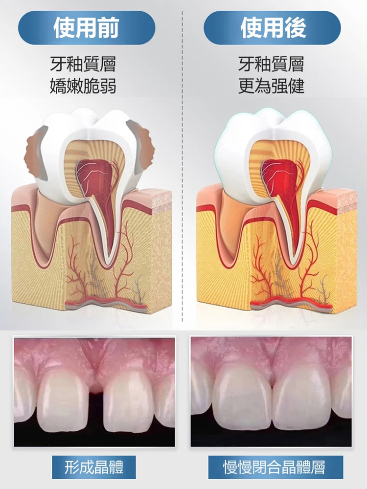 醫用級再生矽牙科分離劑