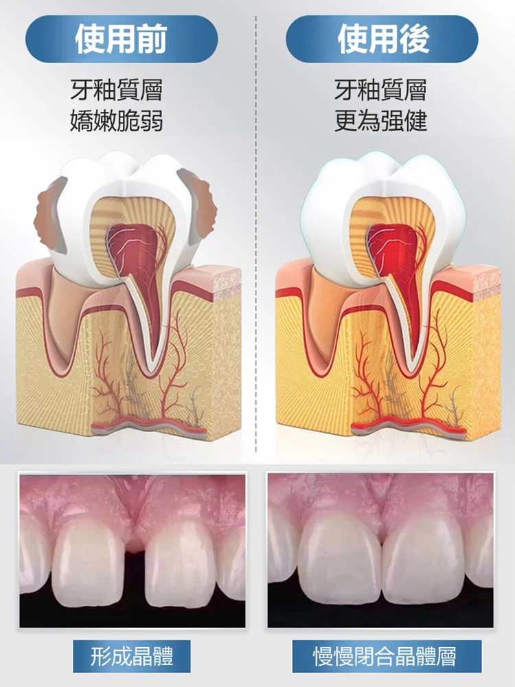 醫用級再生矽牙科分離劑