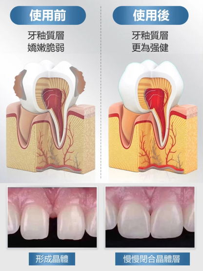 醫用級再生矽牙科分離劑