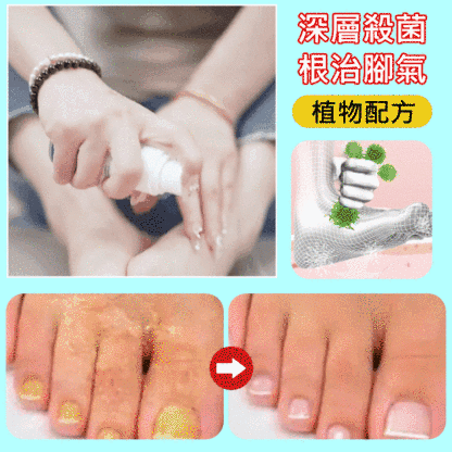 【脚輕鬆】殼聚糖腳氣脚蘚噴霧劑