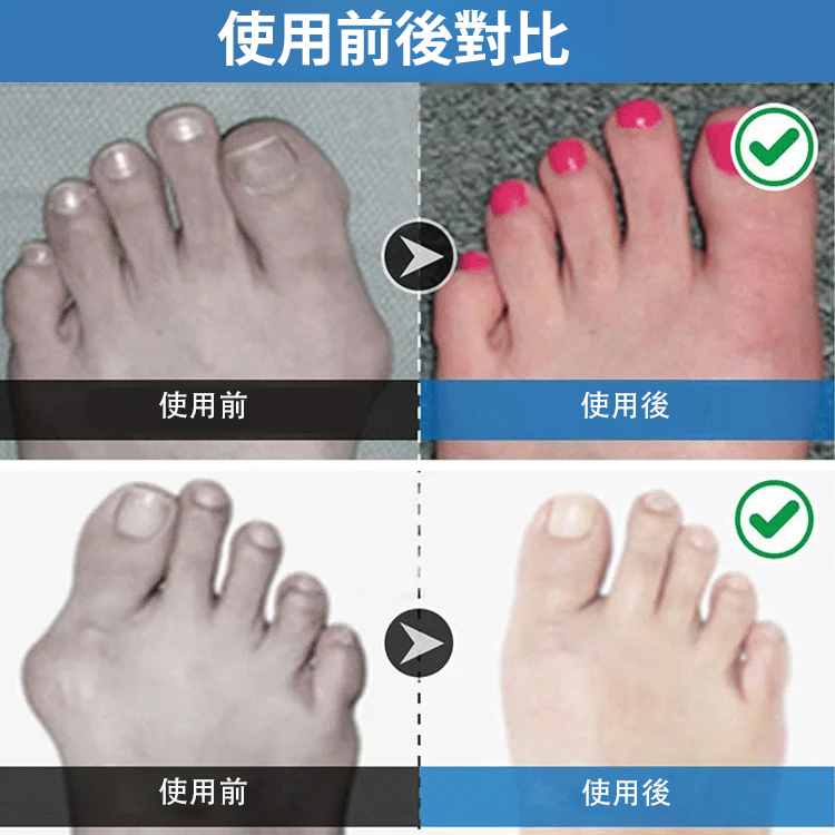 【醫療用】大腳骨拇指外翻分趾器