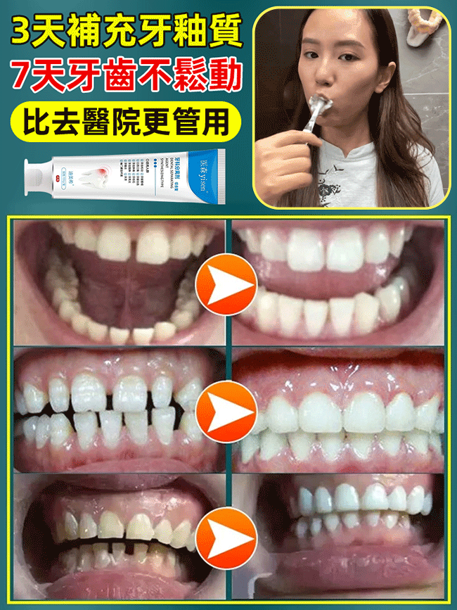 醫用級再生矽牙科分離劑