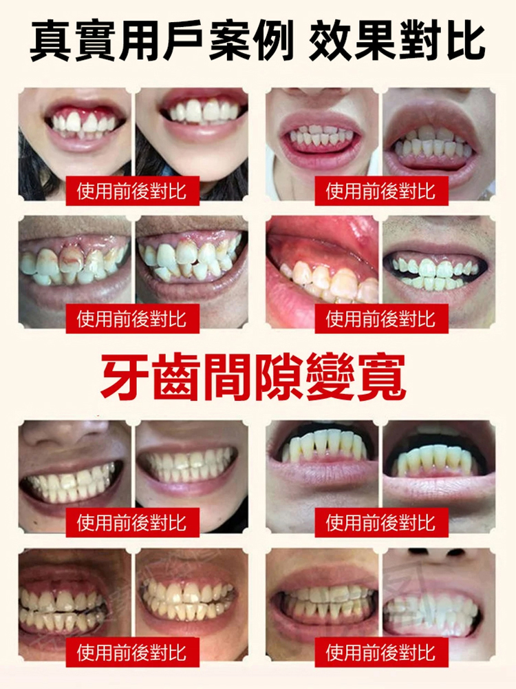 醫用級再生矽牙科分離劑