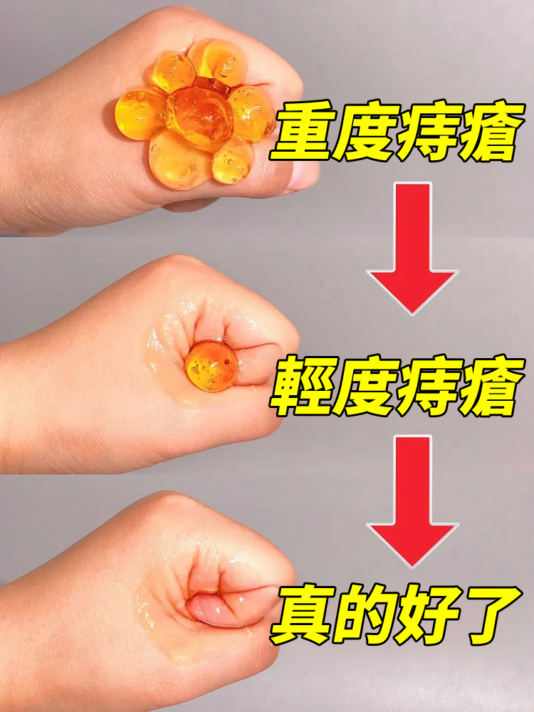 醫用痔瘡凝膠