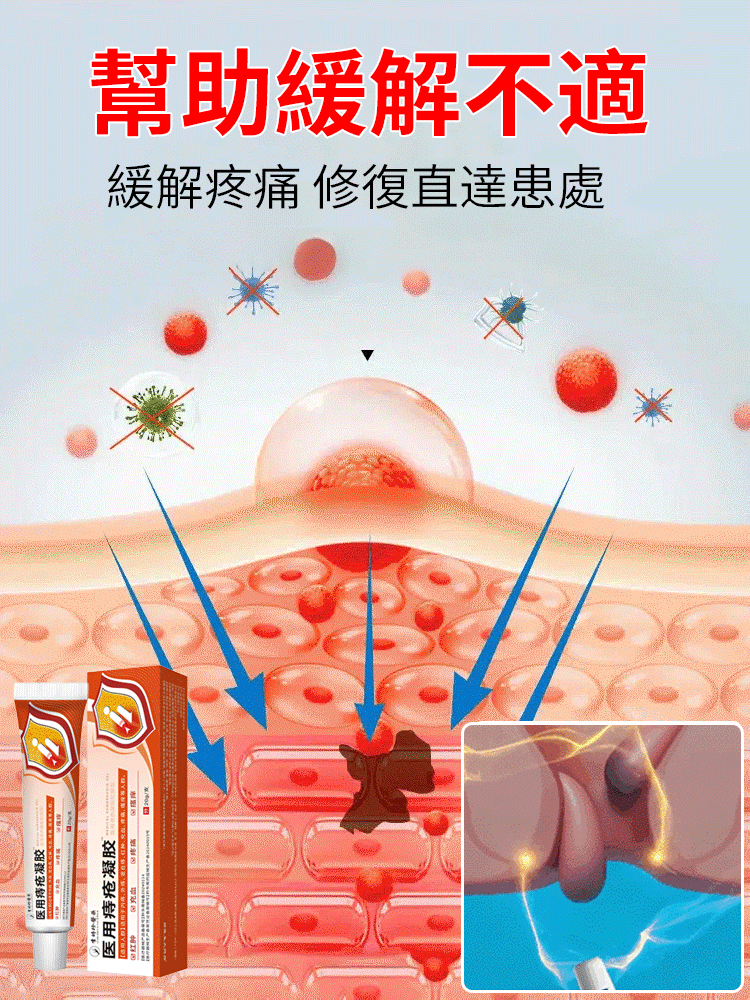 醫用痔瘡凝膠