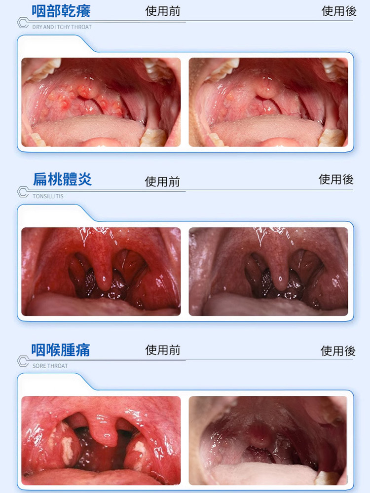咽扁型退燒凝膠-咽炎剋星!官方正品,大品牌可信賴,